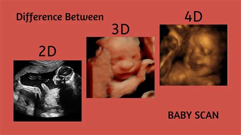 Understanding 3D and 4D Sonography