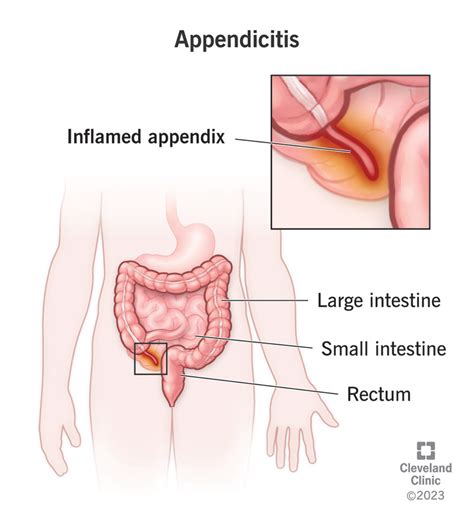 Understanding Appendicitis What You Need to Know