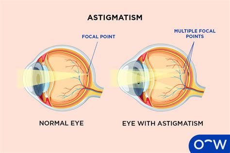 Understanding Astigmatism: Why Axis Matters