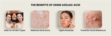 Understanding Azelaic Acid