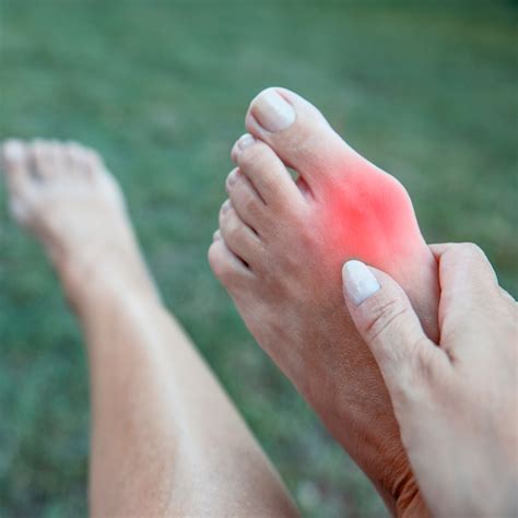 Understanding Bunions: Causes, Symptoms, and Treatment Options