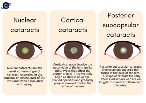 Understanding Cataracts and Treatment Options