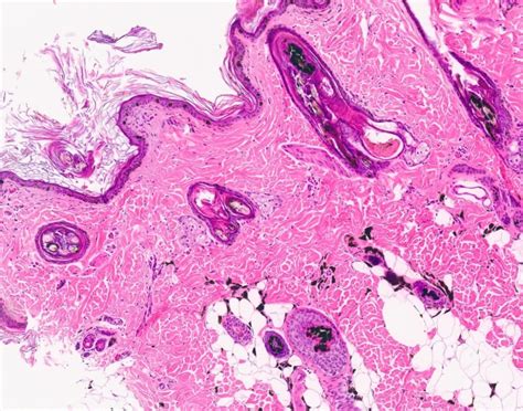 Understanding Color Dilution Alopecia (CDA)