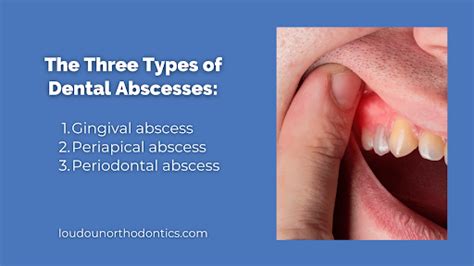 Understanding Dental Abscesses: Types and Risks