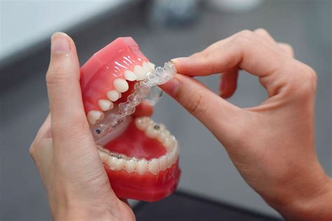 Understanding Dental Implants and Invisalign
