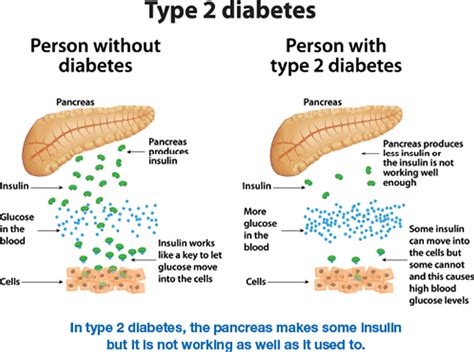 Understanding Diabetes Types: Its Not Just Type 2