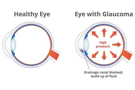 Understanding Diabetic Glaucoma Risk