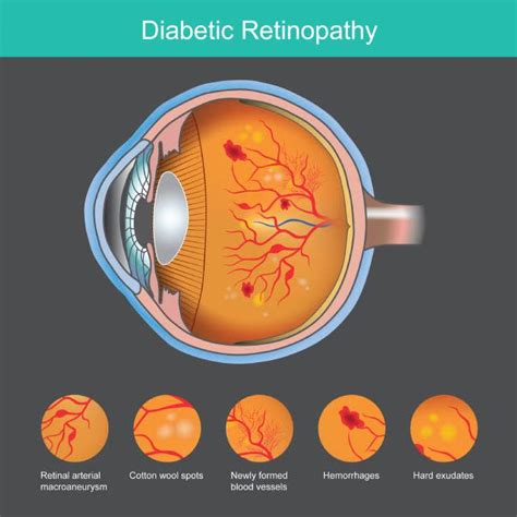 Understanding Diabetic Retinopathy Screenings