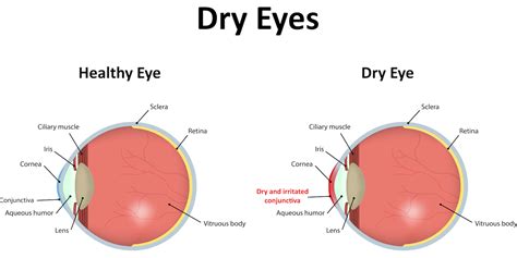 Understanding Dry Eye Syndrome