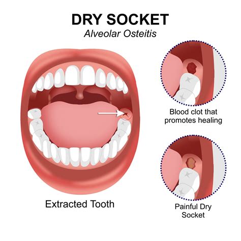 Understanding Dry Socket: A Quick Refresher