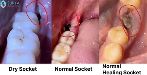 Understanding Dry Socket Your Biggest Enemy