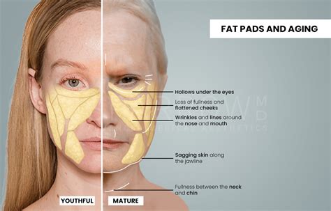 Understanding Facial Fat: Why Does It Happen?