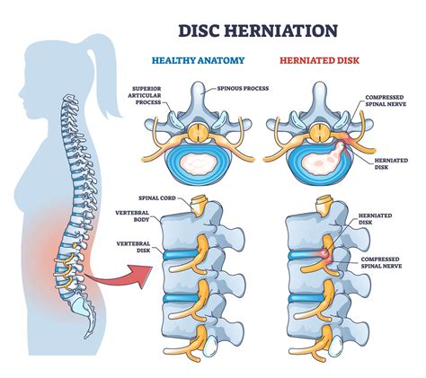 Understanding Herniated Discs and Their Impact