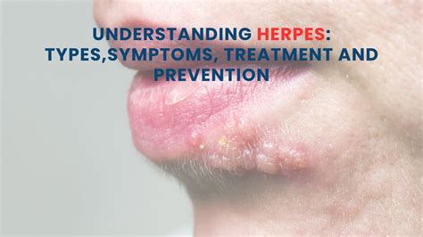 Understanding Herpes Types and Testing