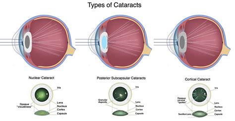 Understanding How Cataracts Develop