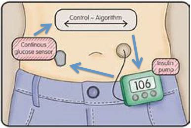 Understanding Hybrid Closed-Loop Systems