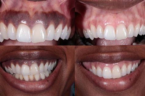 Understanding Laser Depigmentation (The Risks)