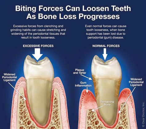 Understanding Loose Teeth What Causes Them