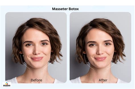 Understanding Masseter Botox