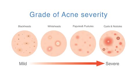 Understanding Mental Health Acne