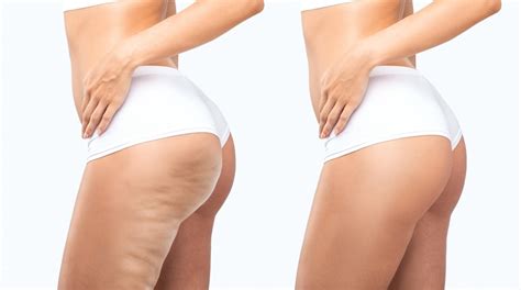 Understanding Mental Health Alternatives for Cellulite Reduction