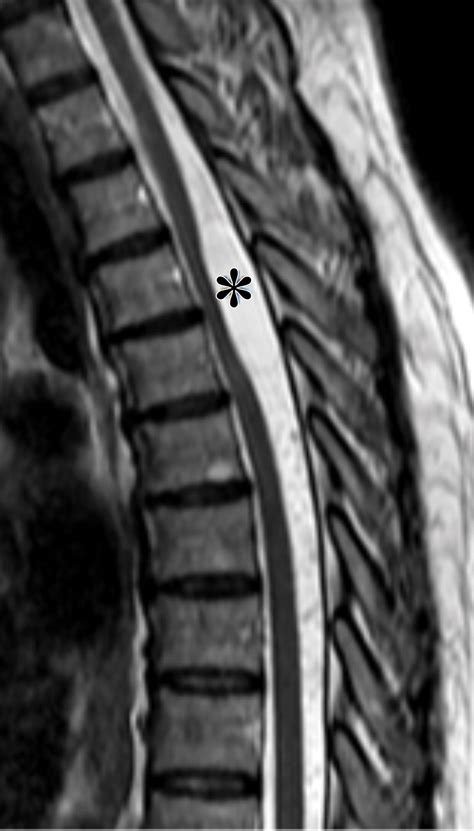 Understanding Myelograms What Are They