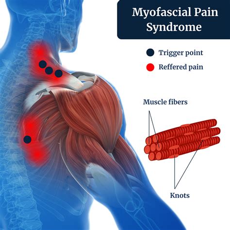 Understanding Myofascial Pain