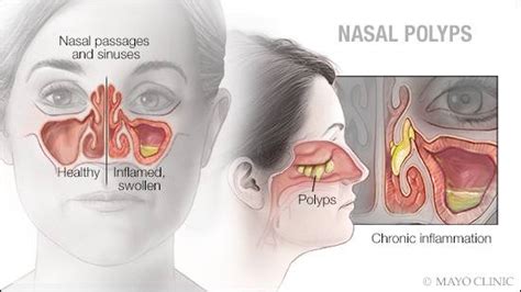 Understanding Nasal Polyps