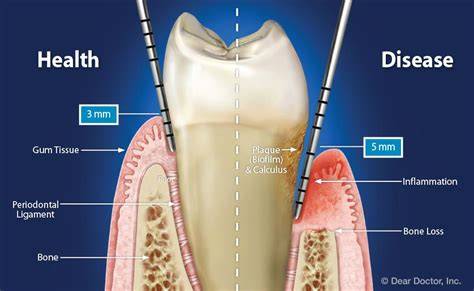 Understanding Periodontal Disease