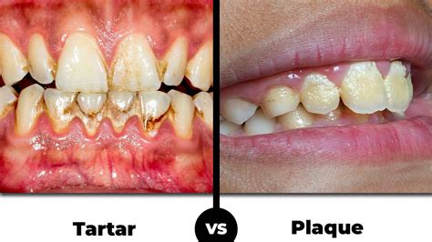 Understanding Plaque and Tartar Buildup