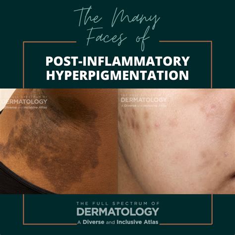 Understanding Post-Inflammatory Hyperpigmentation (PIH)