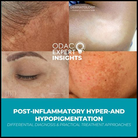 Understanding Post-Inflammatory Hypopigmentation (Loss of Color)