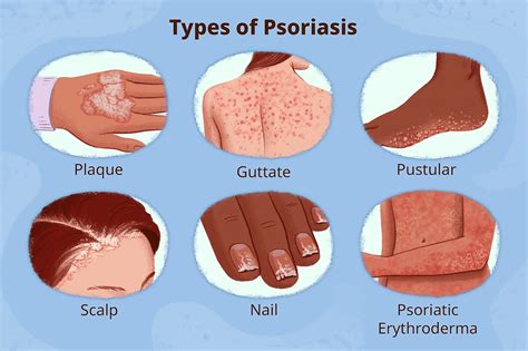 Understanding Psoriasis in Japan