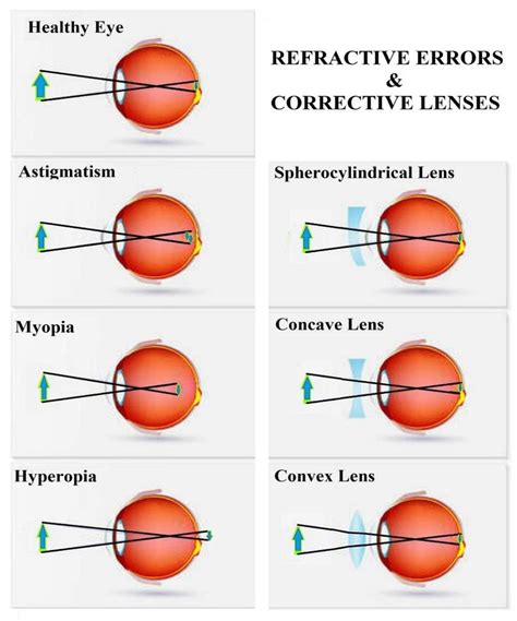 Understanding Refractive Errors: The Core Problem Laser Surgery Addresses