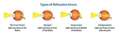 Understanding Refractive Errors (Why You Need LASIK)