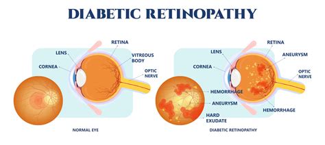 Understanding Retina-Related Issues