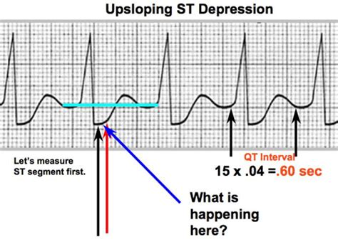 Understanding ST Depression 0.5mm