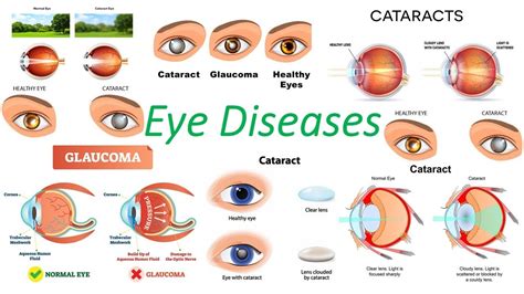 Understanding Serious Eye Diseases