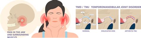 Understanding TMJ and TMD