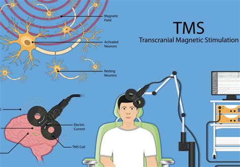 Understanding TMS Therapy in Atlanta