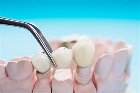 Understanding Tooth Crowns