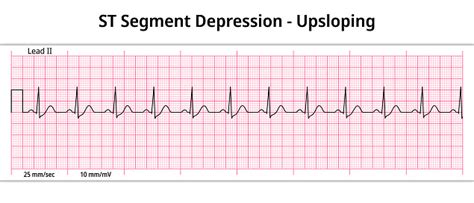 Understanding Upsloping ST Depression