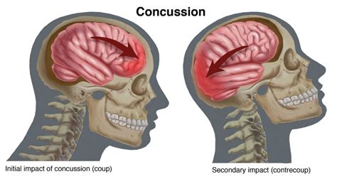 Understanding What a Concussion Really Is