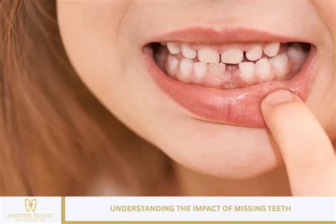 Understanding Your Concerns About Missing Back Teeth
