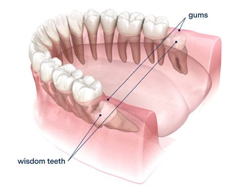 Understanding Your Wisdom Teeth What Are They