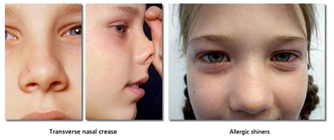 Understanding the "Allergic Shiners" Phenomenon