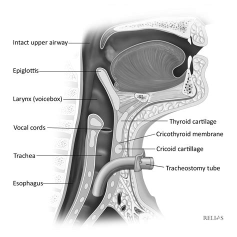 Understanding the Anatomy of a Tracheostomy