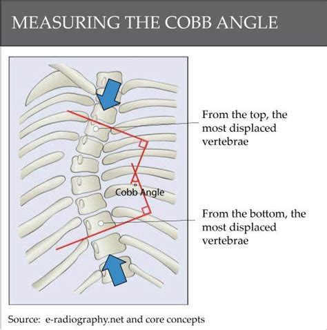 Understanding the Cobb Angle Thresholds