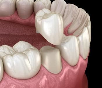 Understanding the Cost of Tooth Extractions