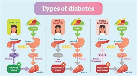 Understanding the Different Types of Diabetes